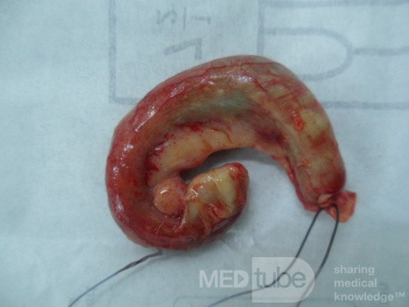 Acute appendicitis with visible lymph node