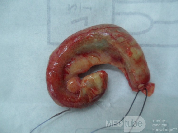 Acute appendicitis with visible lymph node