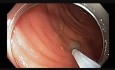 Colonoscopy - Submucosal injection technique