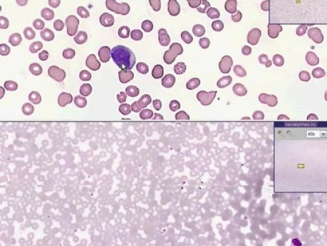 Acute leukemia - Histopathology - Blood