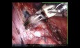 Left Lower Lobectomy to Treat Inflamatory Lung Disease