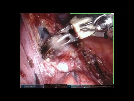 Left Lower Lobectomy to Treat Inflamatory Lung Disease