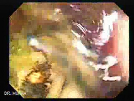 Colonoscopic Polypectomy (17 of 18)