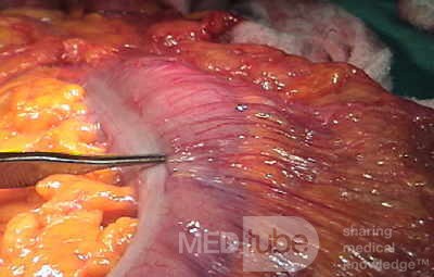 Endoscopic Image of Adenocarcinoma of the Transverse Colon (5 of 9)