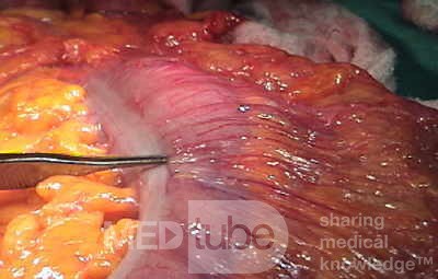 Endoscopic Image of Adenocarcinoma of the Transverse Colon (5 of 9)