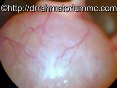 Massive Vallecula Cyst