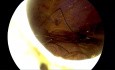 Laparoscopic Repair of a Left Traumatic Diaphragmatic Rupture (Diaphragmatic Hernia)