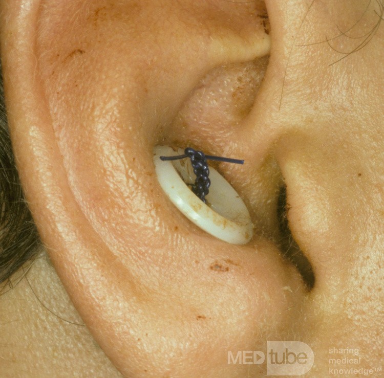 Small Hematoma of the Pinna After Drainage