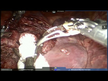 Cystic Mediastinal Tumor