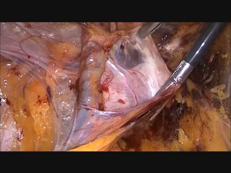 TEP Hernioplasty