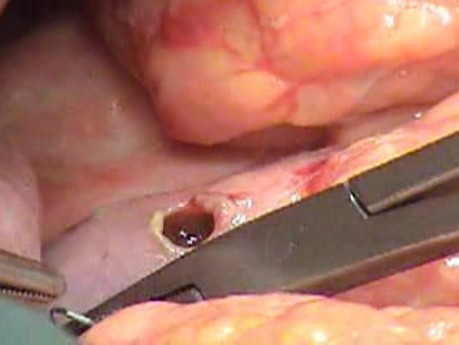 Multiple Rectal Ulcers (49 of 110)