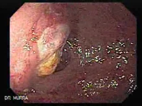 Gastrointestinal Stromal Tumour of the Rectum (2 of 3)