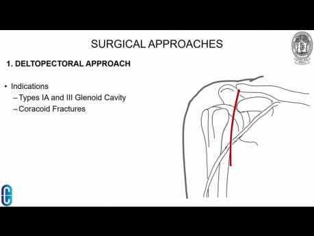 Scapula Fracctures