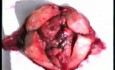 Total Hysterectomy Performed for Endometrial Cancer