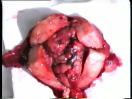 Total Hysterectomy Performed for Endometrial Cancer