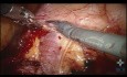 Robotic-assisted Ureteral Reimplatation with Psoas Bladder Hitch