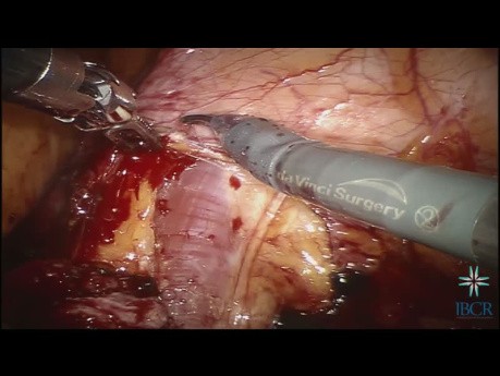 Robotic-assisted Ureteral Reimplatation with Psoas Bladder Hitch