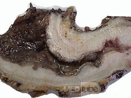Plastic Linitis with bilateral Krukenberg´s tumor (10 of 13)
