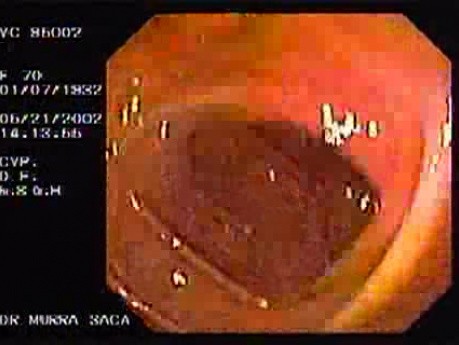 A Tablet of Medicine in the Colon (2 of 2)