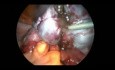 Laparoscopic Surgery For Endometriosis Stage 4