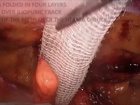 Three Different Types of ProGrip Mesh in TAPP Hernia Repair
