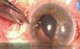 IOL Scleral Fixation & Express