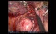 Robotic D2 Gastrectomy - Full-length Procedure