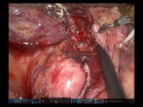 Robotic D2 Gastrectomy - Full-length Procedure