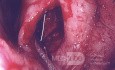Left Lateral Wall Implant - Empty Nose Syndrome