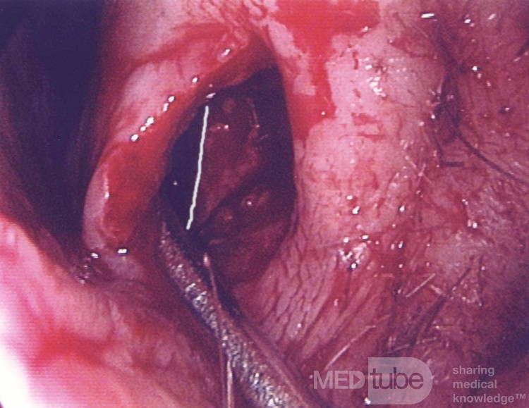 Left Lateral Wall Implant - Empty Nose Syndrome