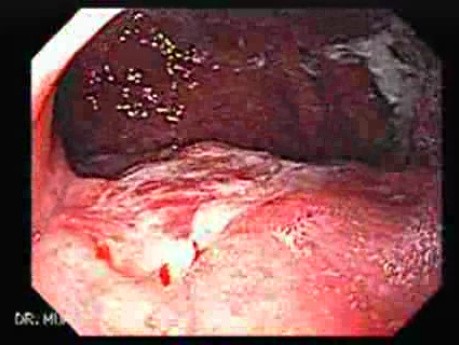 Adenocarcinoma of Cardia with Signet Ring Cells (1 of 6)