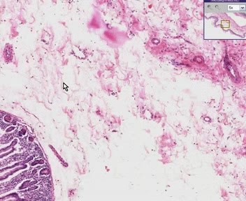 Small Intestine - Edema