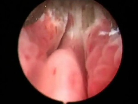 Greenlight HPS Prostatectomy - Part 1