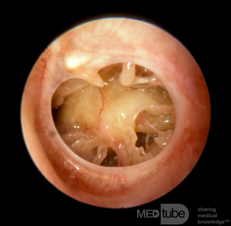 Large Subtotal Perforation [left tympanic membrane]