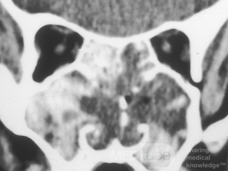 Severe Allergic Fungal Sinusitis [CT scan]