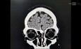 Endoscopic Excision of Encephalocele and Repair of Skull Base Defect