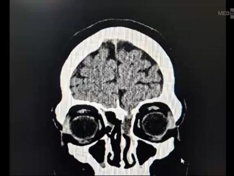 Endoscopic Excision of Encephalocele and Repair of Skull Base Defect