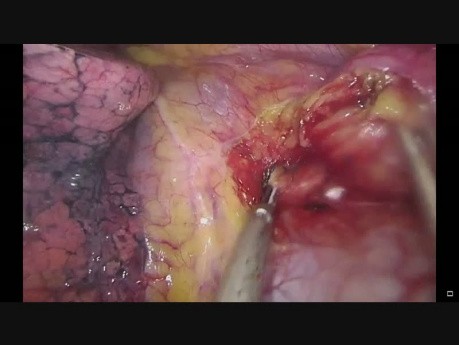Uniportal VATS Resection of Mediastinal Mass
