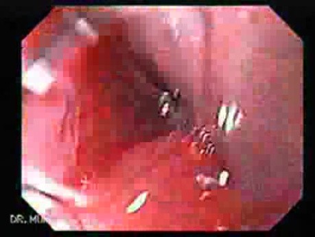 Barrett Adenocarcinoma of Gastroesophageal Junction - Endoscopic Assessment