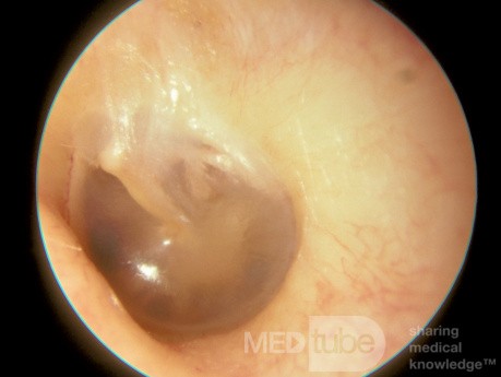 Normal Tympanic Membrane