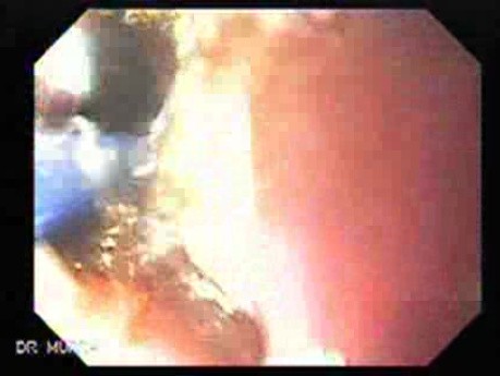 Long Standing Alcohol Abuse - Argon Plasm Coagulation, Part 1