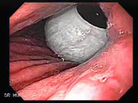 Intragastric Balloon - The Treatment Of Obesity (10 of 13)