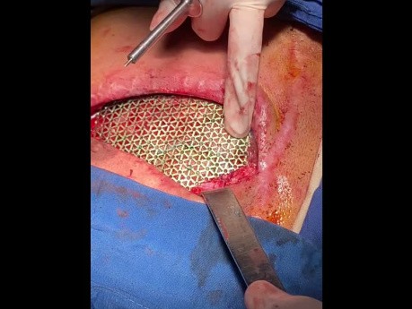 Another Case of Chest Wall Reconstruction (1)