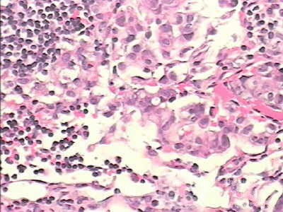 Adenocarcinoma of the cardias and gastric fundus with signet-ring cells (21 of 25)