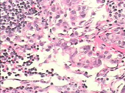 Adenocarcinoma of the cardias and gastric fundus with signet-ring cells (21 of 25)