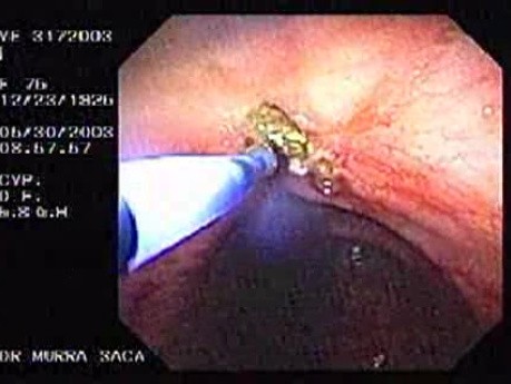 Upper Gastrointestinal Bleeding (7 of 15)