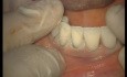 Upper Arch Teeth Preparation And Provisional Crowns (5/5)