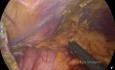 Laparoscopic Total Gastrectomy for the Recurrence in the Remnant Stomach after Open Partial Gastrectomy