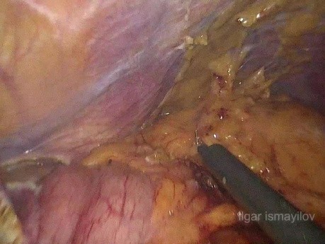 Laparoscopic Total Gastrectomy for the Recurrence in the Remnant Stomach after Open Partial Gastrectomy