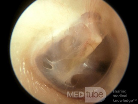 Thin Thickening of the Fibrous Layer Tympanic Membrane